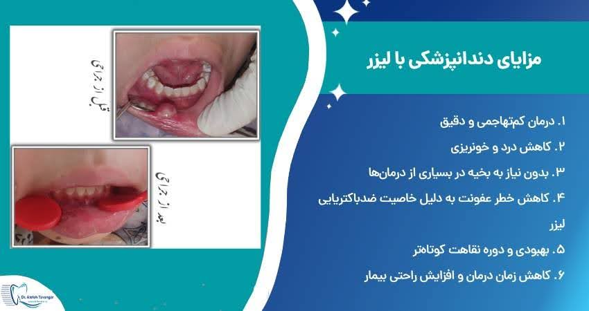 دندانپزشکی با لیزر
