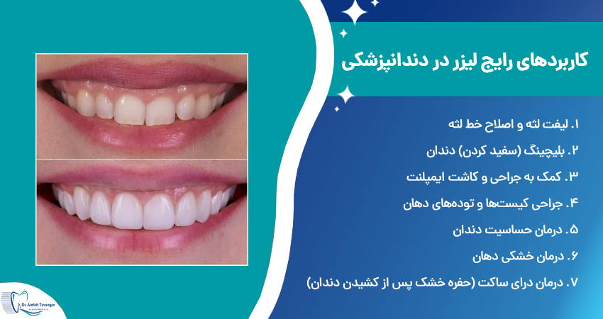 کاربرد های دندانپزشکی با لیزر